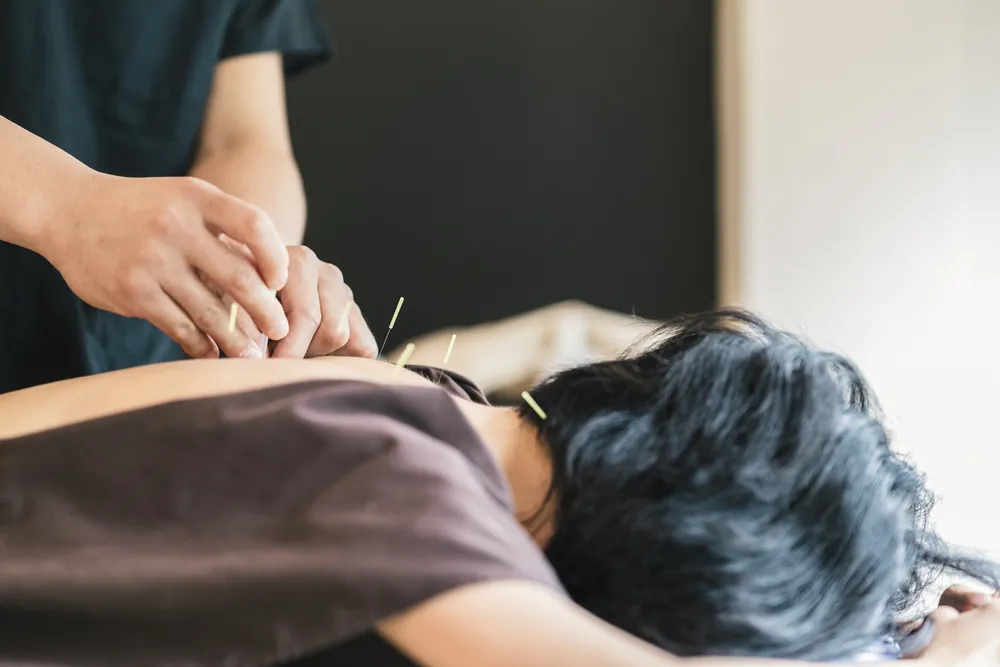 a tcm practitioner doing acupuncture, a tcm chinese medicine procedure